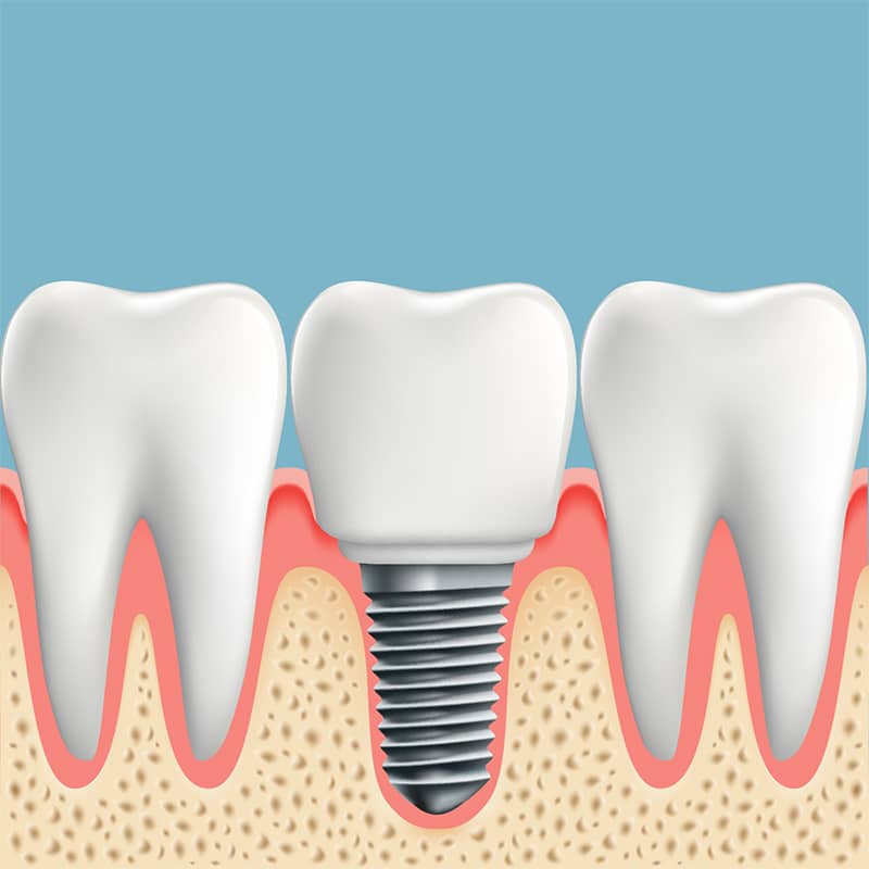 info about dental implants